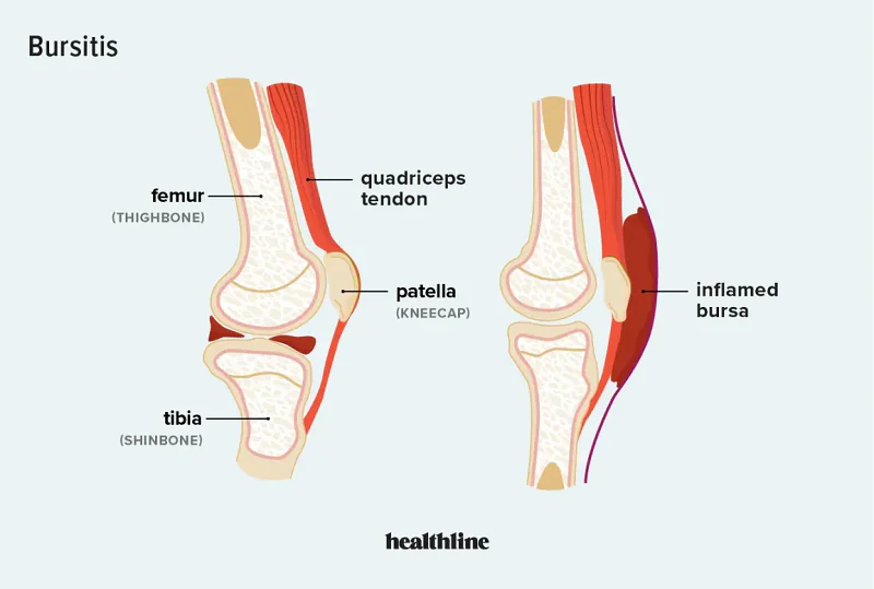 Diagram of knee joint illustrating bursitis.