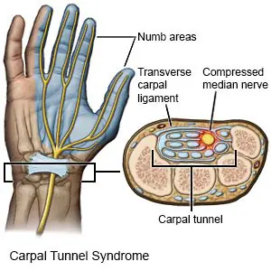 A anatomical diagram showing the carpal tunnel, median nerve, and transverse carpal ligament.