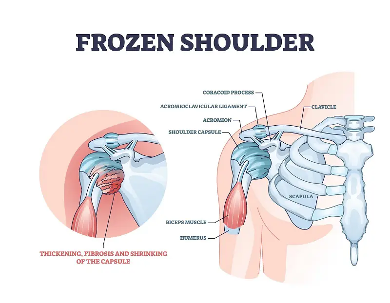 A diagram of a frozen shoulder, which is a condition where the shoulder capsule is thickened and contracted. The diagram shows the bones, ligaments, and muscles of the shoulder joint.