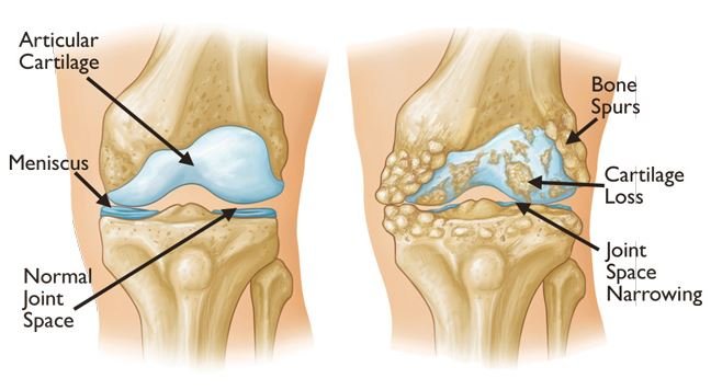 Diagram of a healthy knee joint compared to a knee joint with osteoarthritis. The healthy knee joint has smooth cartilage and a normal joint space. The knee joint with osteoarthritis has rough, worn cartilage and a narrowed joint space.