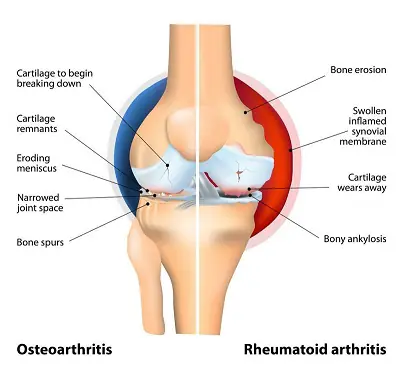 Comparison of osteoarthritis and rheumatoid arthritis in the knee joint.