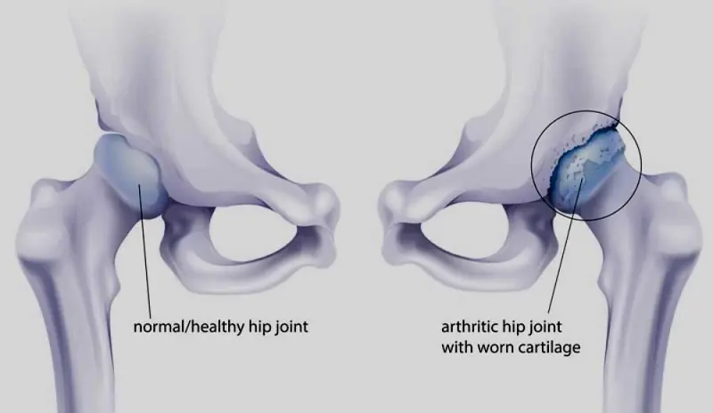Diagram of a normal healthy hip joint and an arthritic hip joint with worn cartilage.