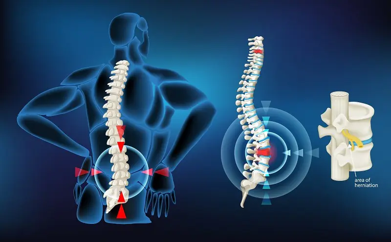 Illustration of spinal herniation with highlighted areas of pain and a detailed view of the affected vertebrae.