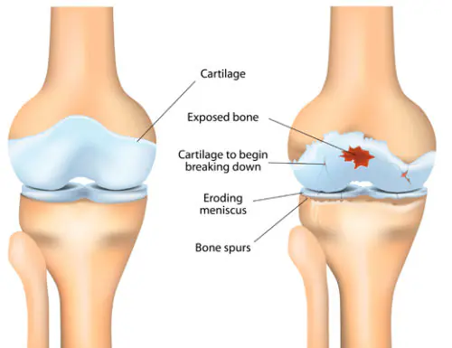 Comparison of a healthy knee joint and an osteoarthritic knee joint.