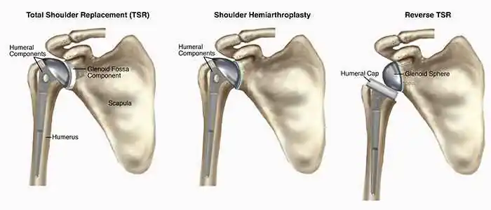 Illustration of three types of shoulder replacement surgeries.