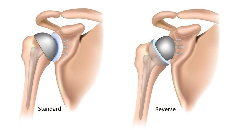 Comparison of standard and reverse shoulder replacement implants.
