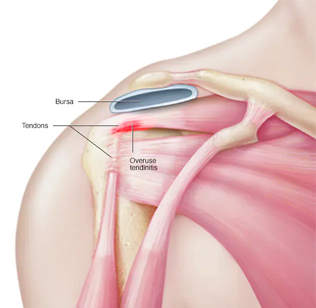 Illustration of overuse tendinitis in the shoulder.