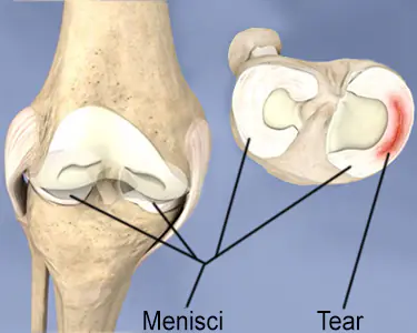 Close-up of a knee joint showing a tear in the meniscus, a C-shaped piece of cartilage that cushions the joint.