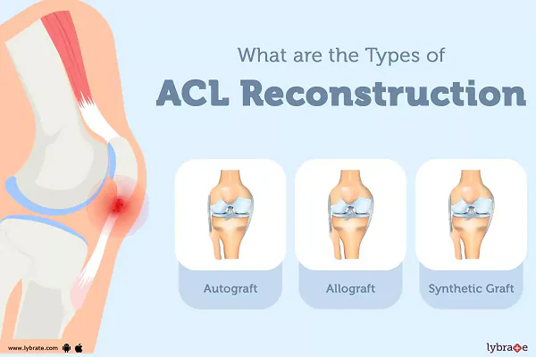 Diagram showing types of ACL reconstruction: autograft, allograft, and synthetic graft.