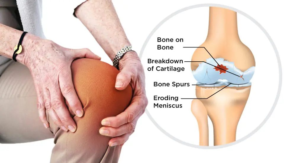 Diagram of a knee with labeled areas of bone on bone contact, breakdown of cartilage, bone spurs, and erosion of meniscus.