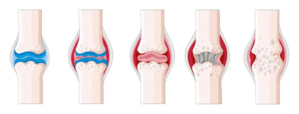 Four stages of osteoarthritis in a knee joint. The first stage shows a healthy joint. The second stage shows mild wear and tear. The third stage shows moderate wear and tear with some bone spurs. The fourth stage shows severe wear and tear with significant bone spur formation and joint space narrowing.