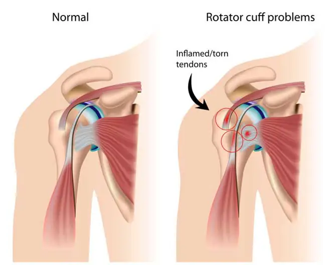 Diagram of a normal shoulder joint and a shoulder joint with a rotator cuff tear.